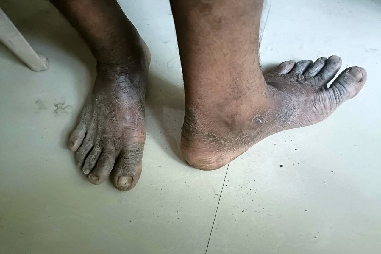 2023 06 Well Digging Case Survivor Feet 3 jpeg 202306 MUM Well Digging Rescue Approved for Full Use